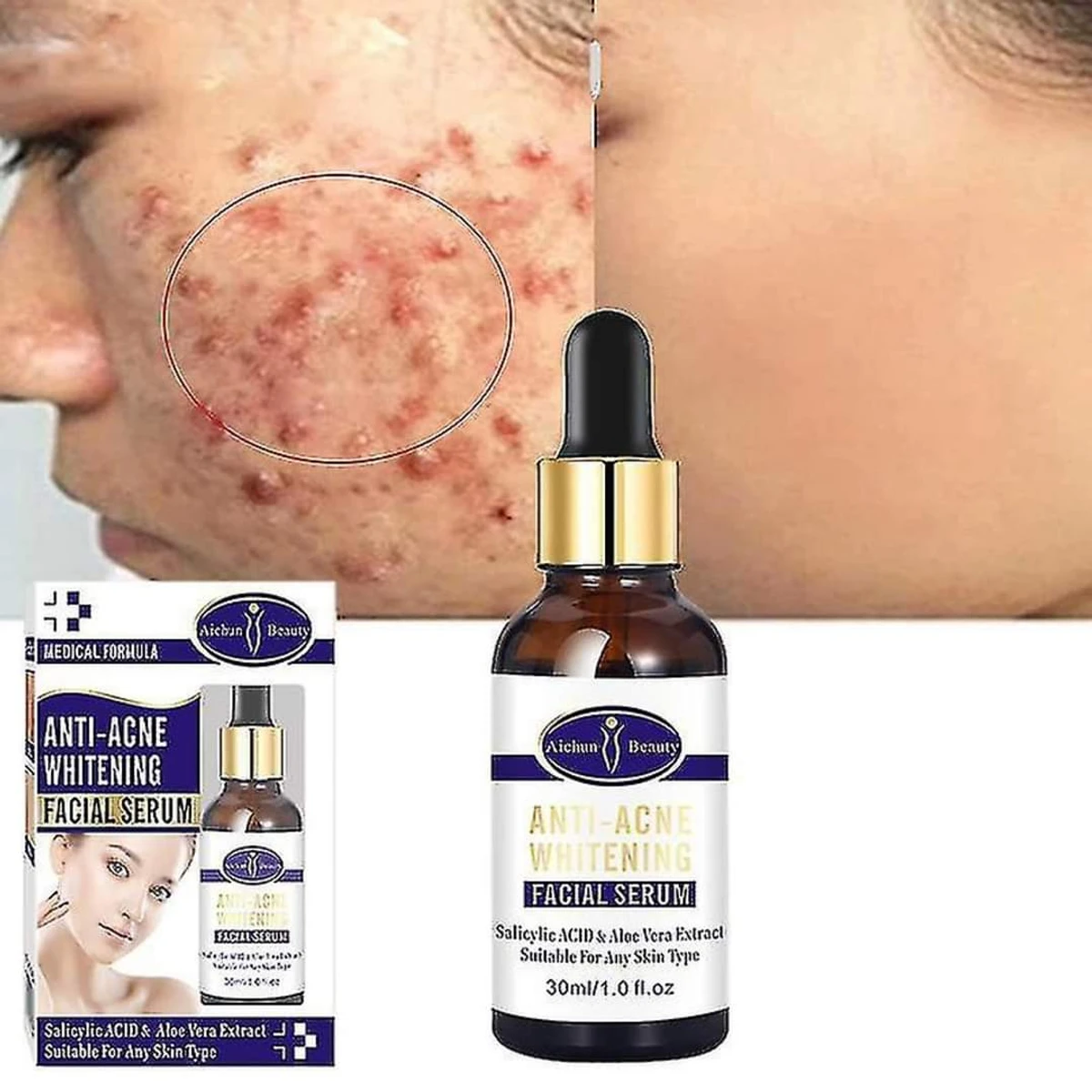 Anti-Acne Whitening Facial Serum